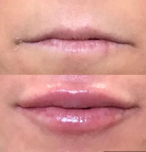 lip fillers before and after image