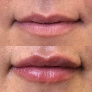 lip fillers before and after image