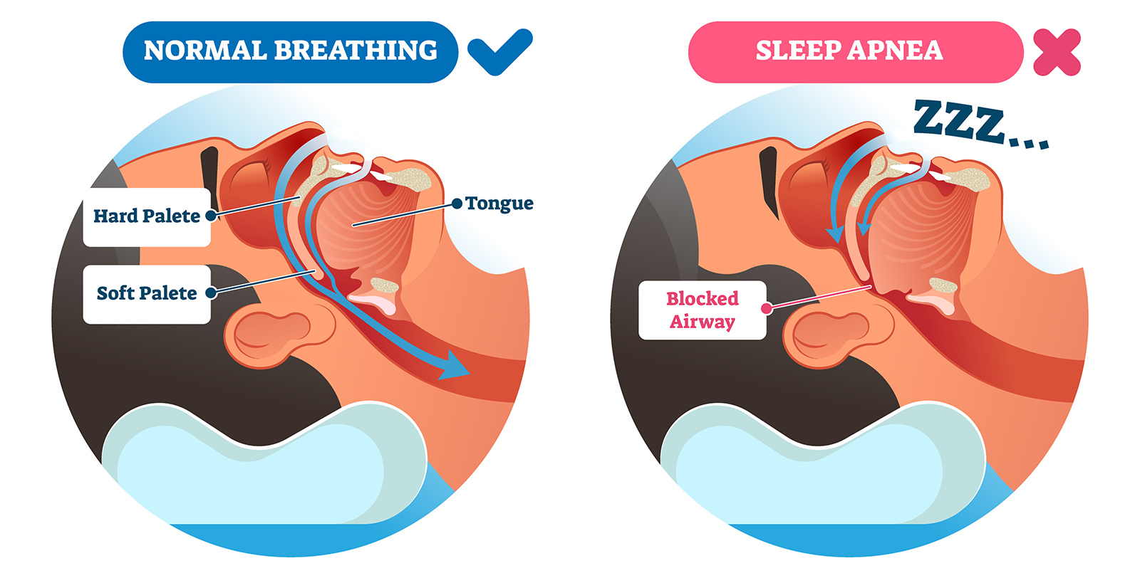 An illustration comparing normal breathing and sleep apnea
