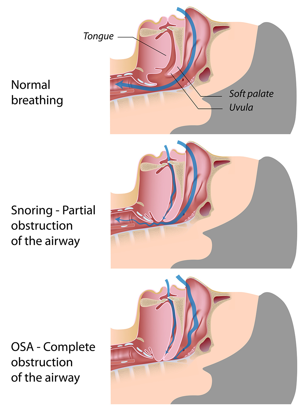 A medical illustration comparing normal breathing, snoring, and an obstructed airway