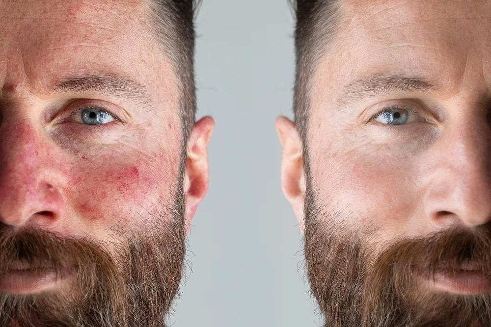 Rosacea